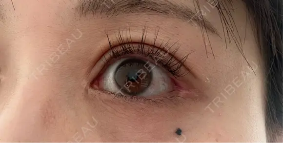 タレ目形成・グラマラスライン（切開） アネシス美容クリニック DAY 54 メイン用