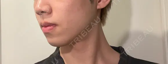 ボトックス（エラ・小顔） / ヒアルロン酸注入（鼻翼基部） KAGA CLINIC DAY 16 メイン用