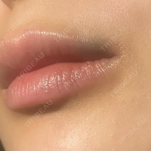 ヒアルロン酸注入（唇） 共立美容外科 大分院 AFTER メイン用