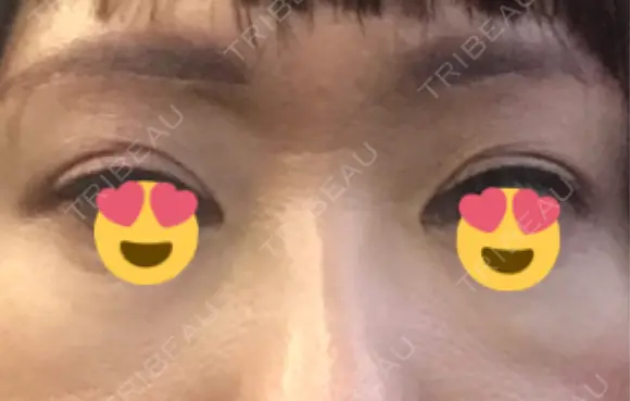 眉下切開 銀座リシェスクリニック DAY 28 メイン用