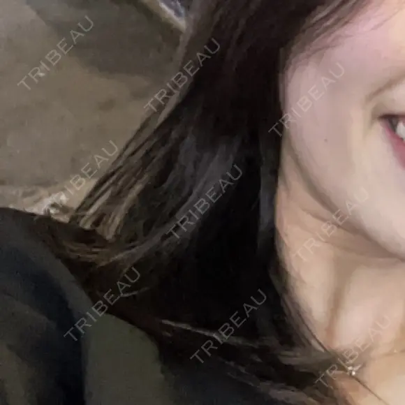 ボトックス（エラ・小顔） TCB東京中央美容外科 梅田茶屋町院 AFTER メイン用