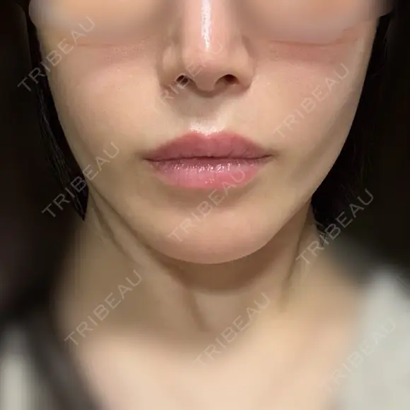 糸リフト / バッカルファット除去 / 脂肪吸引（顔） / ジョールファット除去 BLINC CLINIC （ブリンク クリニック） DAY 113 メイン用