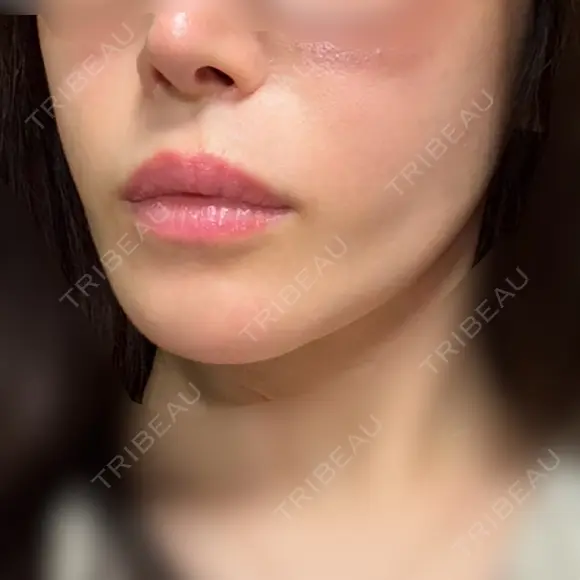 糸リフト / バッカルファット除去 / 脂肪吸引（顔） / ジョールファット除去 BLINC CLINIC （ブリンク クリニック） DAY 113 メイン用