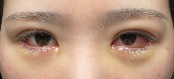 二重埋没 / タレ目形成・グラマラスライン（切開） エターナル美容クリニック DAY 7 メイン用