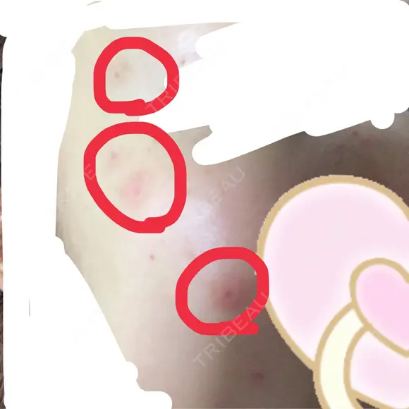 ほくろ・いぼ切除（肌） 赤坂メディカルMクリニック AFTER メイン用