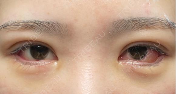 二重埋没 / タレ目形成・グラマラスライン（切開） エターナル美容クリニック DAY 8 メイン用
