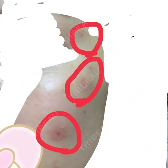 ほくろ・いぼ切除（肌） 赤坂メディカルMクリニック DAY 17 メイン用