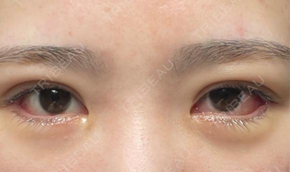 二重埋没 / タレ目形成・グラマラスライン（切開） エターナル美容クリニック DAY 9 メイン用