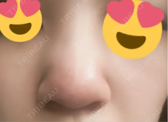 脂肪溶解注射（顔） ファイヤークリニック 銀座院 DAY 0 メイン用