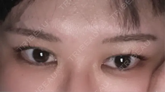 アートメイク（眉） G MEDICAL ART クリニック 新宿院 AFTER メイン用