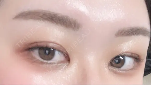 アートメイク（眉） G MEDICAL ART クリニック 新宿院 DAY 7 メイン用