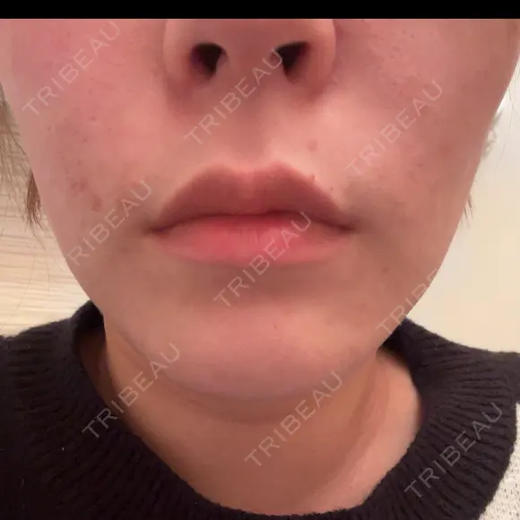 ボトックス（あご） / ボトックス（口角） MAクリニック 心斎橋 DAY 1 メイン用