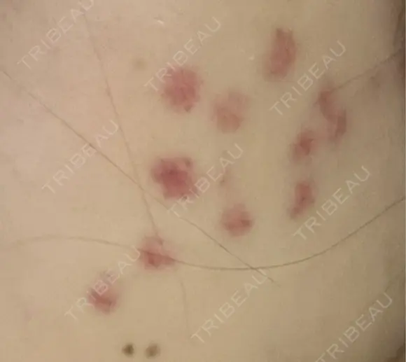 その他（肌） / 美肌レーザー こまちクリニック DAY 3 メイン用