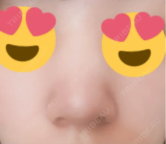 脂肪溶解注射（顔） ファイヤークリニック 銀座院 DAY 1 メイン用