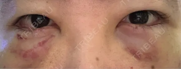下まぶたたるみ取り / 下まぶたの脂肪取り 湘南美容クリニック 千葉センシティ院 DAY 2 メイン用