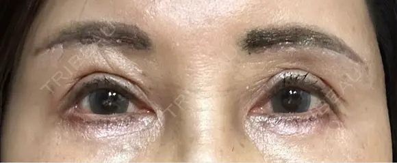 二重切開 / 眼瞼下垂（切開） / 上まぶたたるみ取り / 眉下切開 / 脂肪吸引注射（顔） / 肌ヒアルロン酸注入（たるみ・シワ改善） 東京シンデレラ美容外科 新宿院 DAY 11 メイン用
