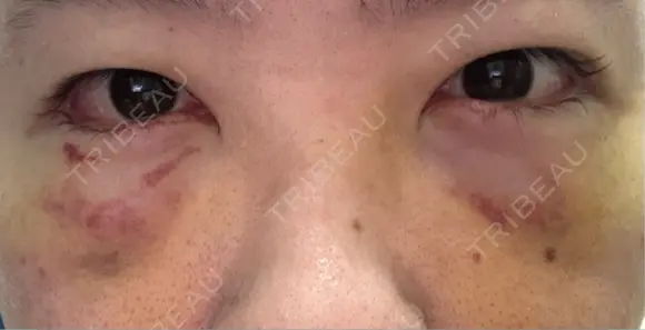 下まぶたたるみ取り / 下まぶたの脂肪取り 湘南美容クリニック 千葉センシティ院 DAY 3 メイン用
