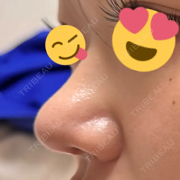 鼻尖形成（切開） / 軟骨移植 / 鼻尖縮小 / 鼻翼基部形成（貴族手術） / ヒアルロン酸注入（鼻翼基部） 東京シンデレラ美容外科 新宿院 DAY 20 メイン用