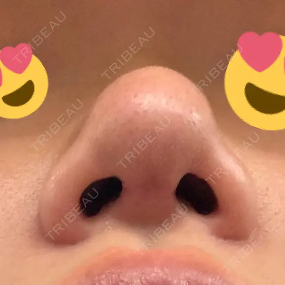 鼻尖形成（切開） / 軟骨移植 / 鼻尖縮小 / 鼻翼基部形成（貴族手術） / ヒアルロン酸注入（鼻翼基部） 東京シンデレラ美容外科 新宿院 DAY 20 メイン用