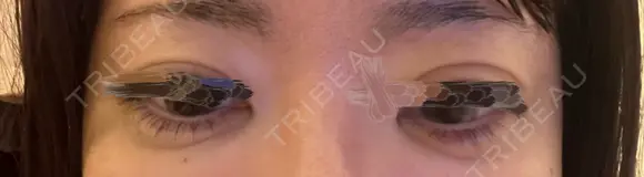 ヒアルロン酸注入（涙袋） / ヒアルロン酸注入（目の下） ファイヤークリニック 渋谷院 AFTER メイン用