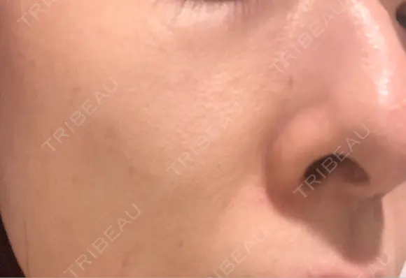 ミラノリピール ミニマムスキンクリニック池袋 DAY 1 メイン用