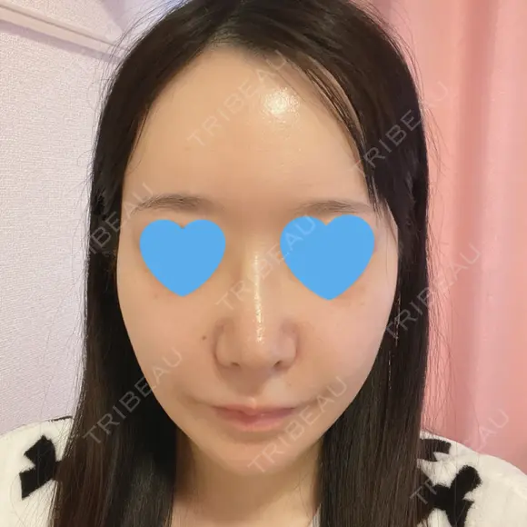 鼻尖形成（切開） / 小鼻縮小（切開） / ワシ鼻修正・ハンプ切除 / 鼻柱下降・鼻唇角形成（猫手術） ASTRA BEAUTY CLINIC DAY 9 メイン用