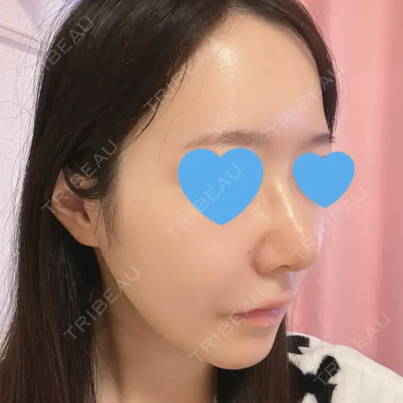鼻尖形成（切開） / 小鼻縮小（切開） / ワシ鼻修正・ハンプ切除 / 鼻柱下降・鼻唇角形成（猫手術） ASTRA BEAUTY CLINIC DAY 9 メイン用