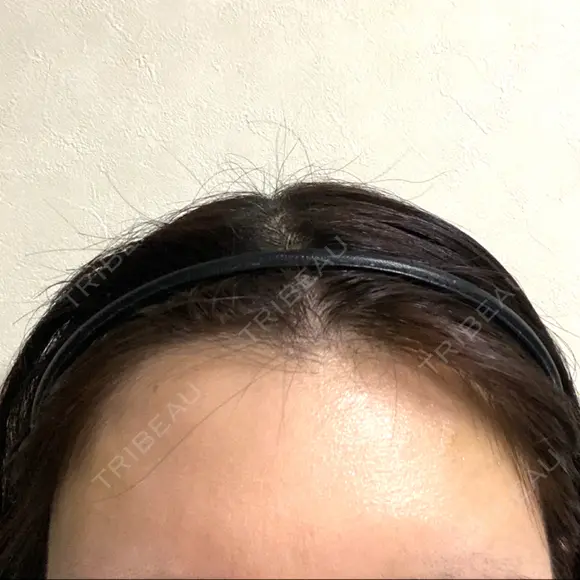 ヒアルロン酸注入（額） / ボトックス（眉間） PRO CLINIC プロクリニック 銀座院 AFTER メイン用