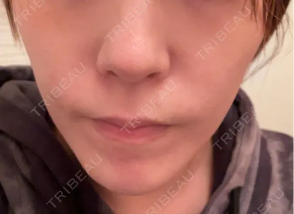 ボトックス（あご） / ボトックス（口角） MAクリニック 心斎橋 DAY 4 メイン用