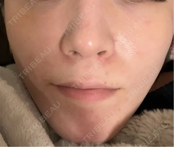 ボトックス（あご） / ボトックス（口角） MAクリニック 心斎橋 DAY 6 メイン用