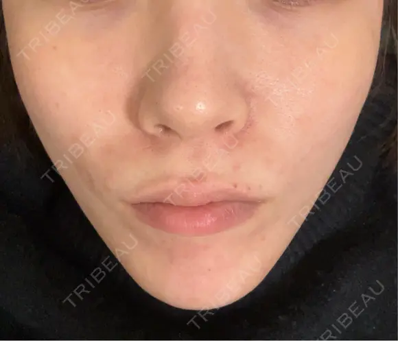 ボトックス（あご） / ボトックス（口角） MAクリニック 心斎橋 DAY 7 メイン用