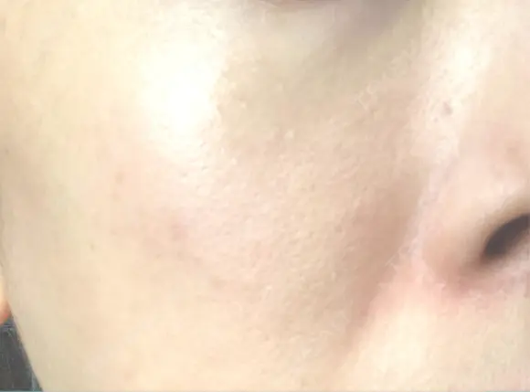 ミラノリピール ミニマムスキンクリニック池袋 DAY 3 メイン用