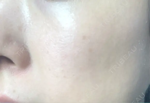 ミラノリピール ミニマムスキンクリニック池袋 DAY 3 メイン用