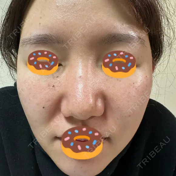 イオン導入 / ルメッカ ルラ美容クリニック 千葉院 / ルラスキンクリニック 千葉院 DAY 4 メイン用