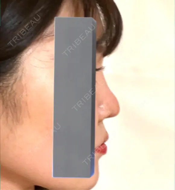 隆鼻術 / 鼻尖形成（切開） / 小鼻縮小（切開） / その他（鼻） / 軟骨移植 / 鼻尖縮小 / 鼻翼基部形成（貴族手術） / 鼻柱下降・鼻唇角形成（猫手術） 東京シンデレラ美容外科 池袋院 DAY 31 メイン用