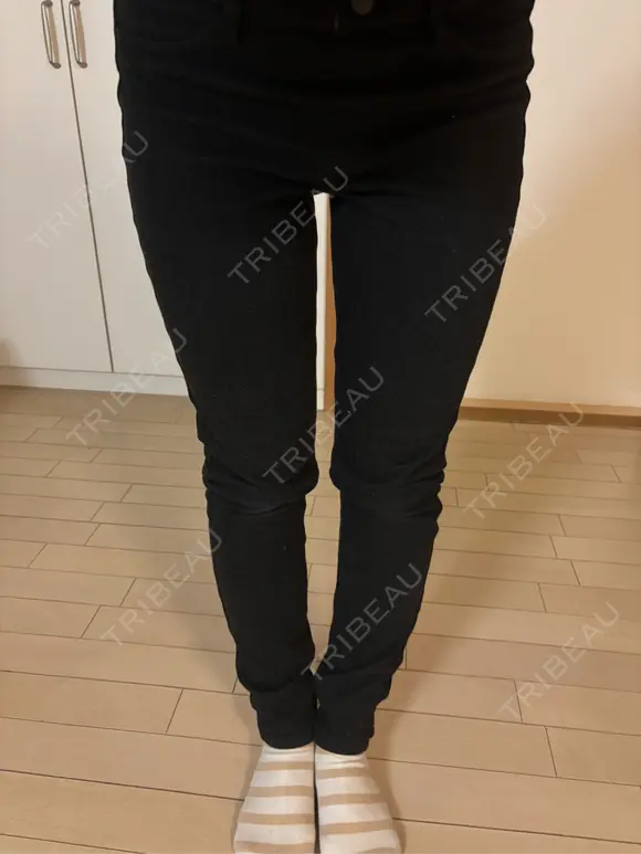 医療痩身（太もも） / 脂肪冷却（太もも） DSクリニック 新宿院 DAY 13 メイン用