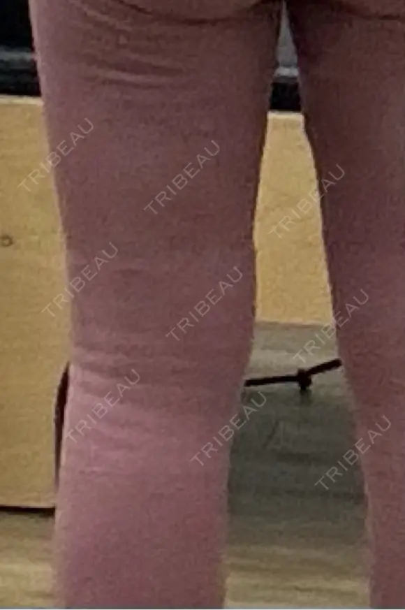 医療痩身（太もも） / 脂肪冷却（太もも） DSクリニック 新宿院 DAY 20 メイン用