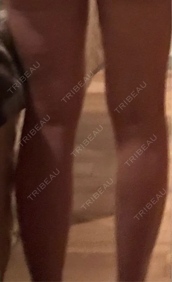 医療痩身（太もも） / 脂肪冷却（太もも） DSクリニック 新宿院 DAY 32 メイン用