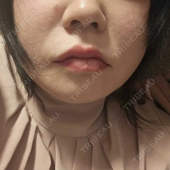 レーザーフェイシャル LIGHT CLINIC 【ライトクリニック】 新宿院 AFTER メイン用