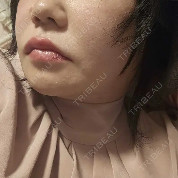 レーザーフェイシャル LIGHT CLINIC 【ライトクリニック】 新宿院 DAY 30 メイン用