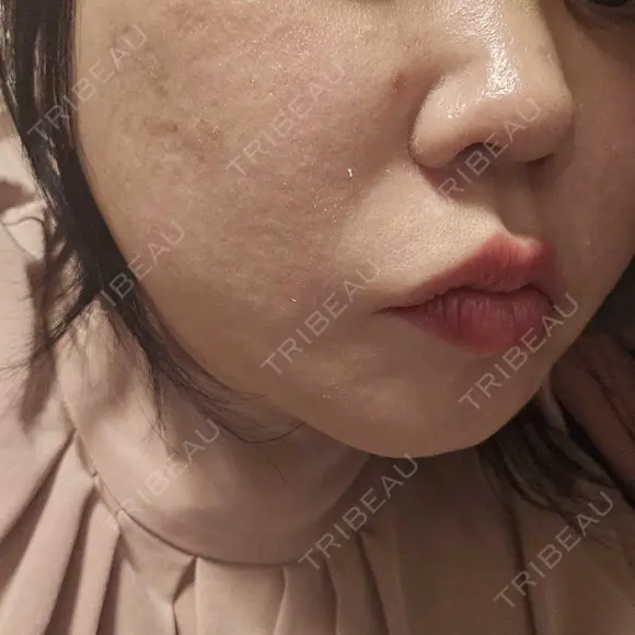 レーザーフェイシャル LIGHT CLINIC 【ライトクリニック】 新宿院 DAY 30 メイン用