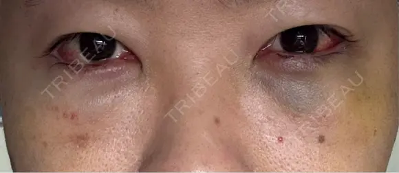 下まぶたたるみ取り / 下まぶたの脂肪取り 湘南美容クリニック 千葉センシティ院 AFTER メイン用