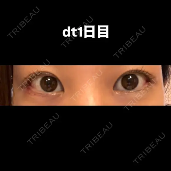 目尻切開 こまちクリニック DAY 2 メイン用