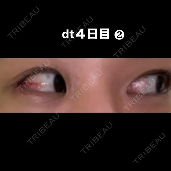 目尻切開 こまちクリニック DAY 4 メイン用
