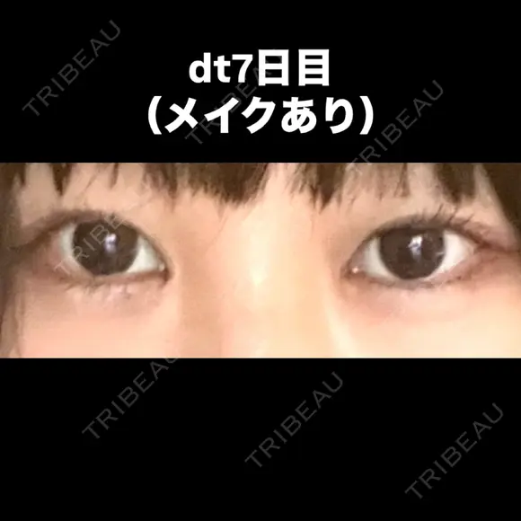 目尻切開 こまちクリニック DAY 7 メイン用