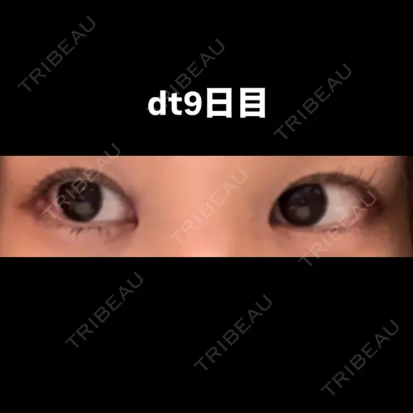目尻切開 こまちクリニック DAY 9 メイン用