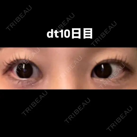 目尻切開 こまちクリニック AFTER メイン用