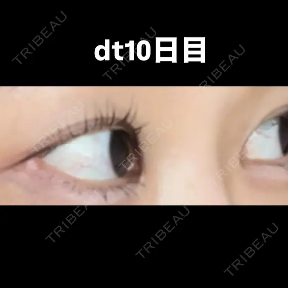 目尻切開 こまちクリニック DAY 10 メイン用