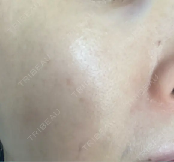 ミラノリピール ミニマムスキンクリニック池袋 DAY 5 メイン用