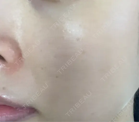 ミラノリピール ミニマムスキンクリニック池袋 DAY 5 メイン用